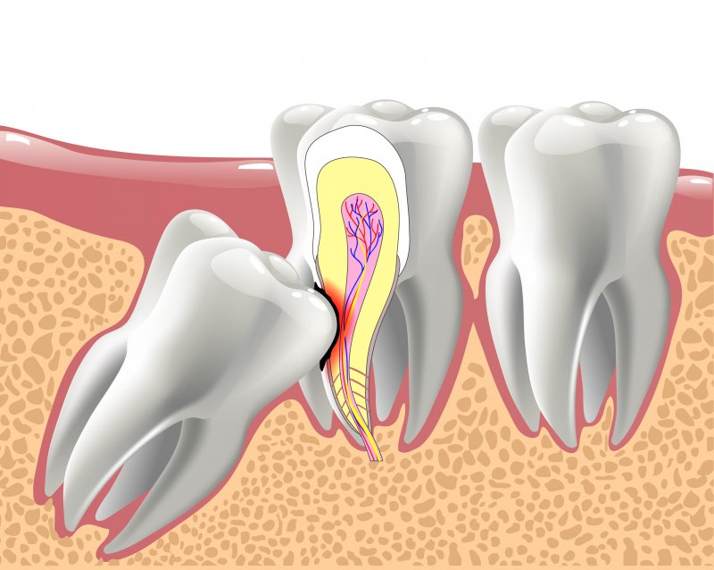 Impacted Wisdom Teeth Marietta Muskingum Valley Oral Surgery