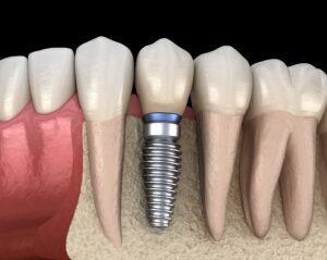 Model of a dental implant in jawbone