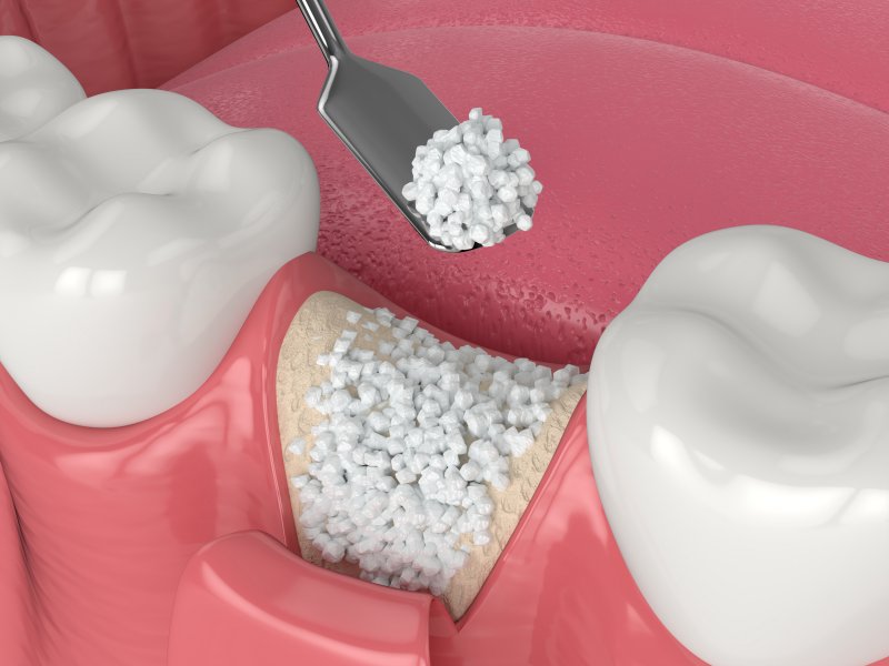 Bone graft illustration